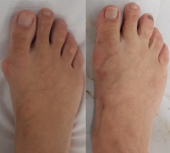 Antes e depois joanete