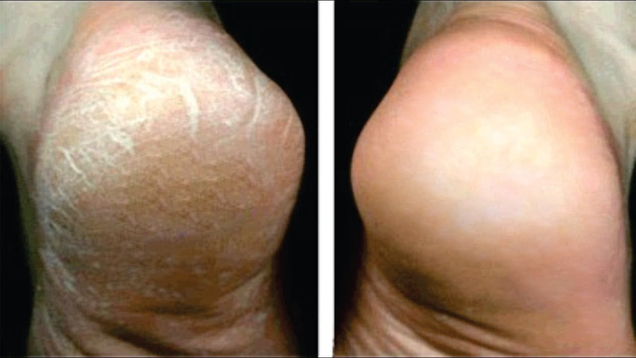 Antes e depois rachaduras